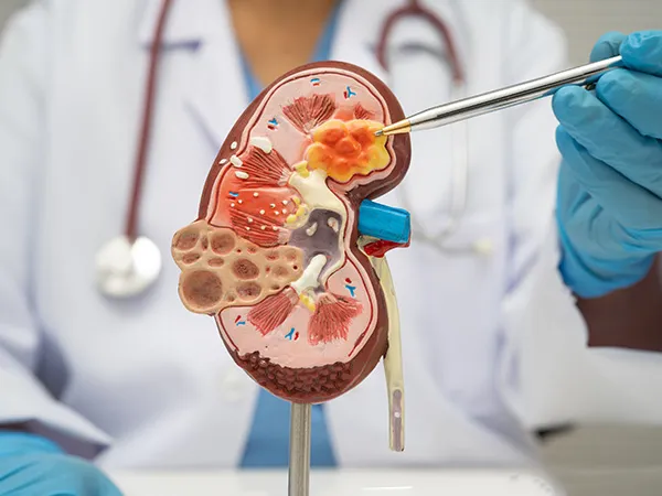 A Complete Guide Covering Kidney Stone Symptoms and Modern Treatment Options