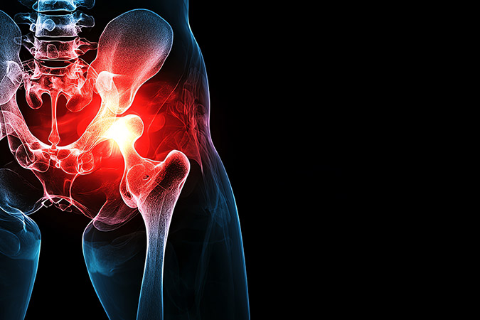 Hip Replacement Surgery Cost in India: Procedure and Recovery Guide