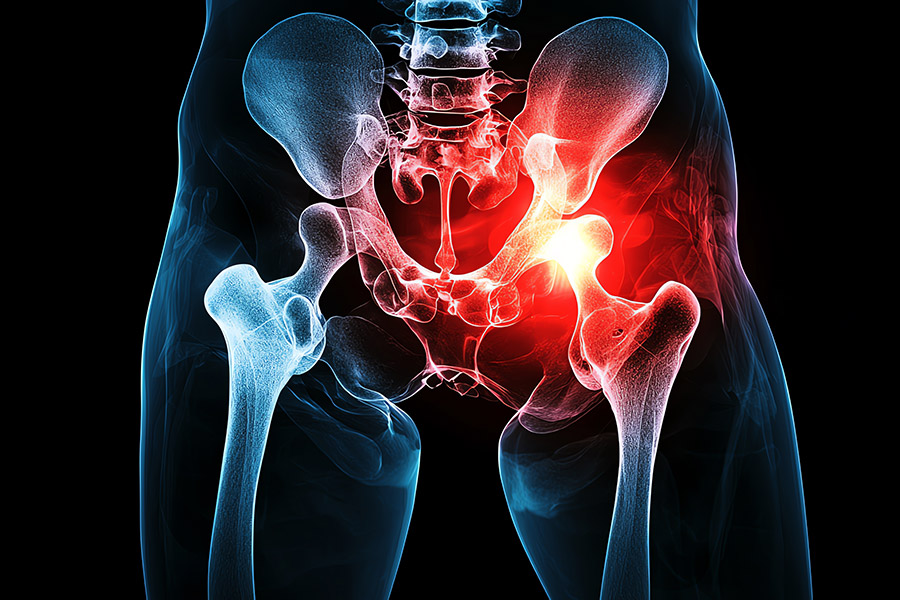 Hip Replacement Surgery Cost in India: Procedure and Recovery Guide