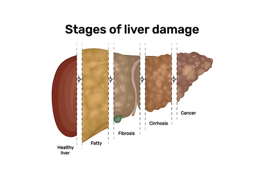 Understanding Fatty Liver Disease: Causes, Symptoms, Diagnosis, Risks, and Treatment Options