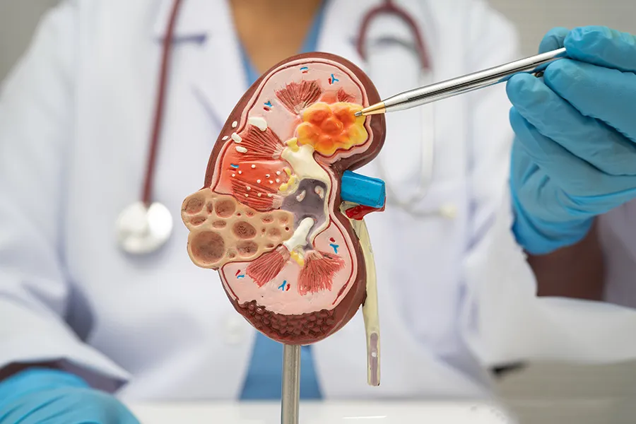 A Complete Guide Covering Kidney Stone Symptoms and Modern Treatment Options