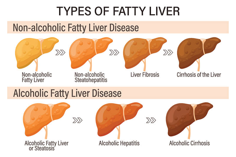 Types of Fatty Liver